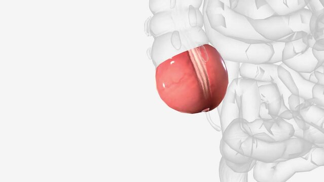 The cecum or caecum is a pouch within the peritoneum that is considered to be the beginning of the large intestine .