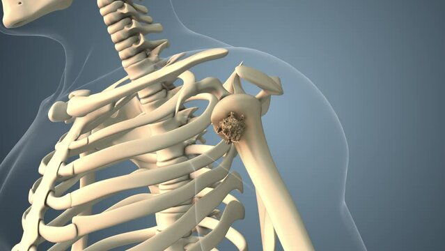 Cancer spreading along shoulder bone