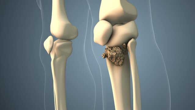 Cancer spreading along a leg bone