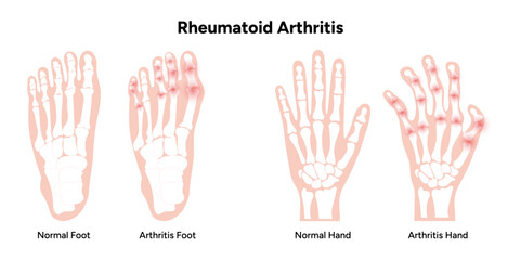 Medical illustration of rheumatoid arthritis and normal hands and feet