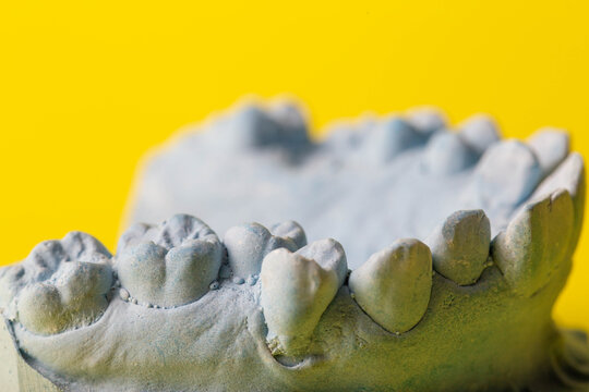 Blue plaster model of an impression of a patient's jaw at an orthodontist dentist on a yellow background. Manufacturing of dentures and crowns for dental prosthetics in orthodontics, macro.