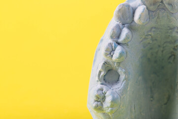Blue plaster impression of a patient's dental jaw with crooked teeth and malocclusions on a yellow...