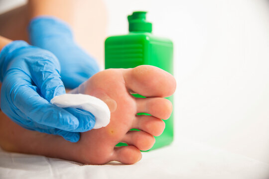 The doctor uses a special liquid to burn a removed callus on the foot. Surgical removal of calluses and warts, close-up
