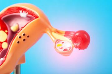 Mockup of the female reproductive system on a blue background with a red inflamed ovary. The...