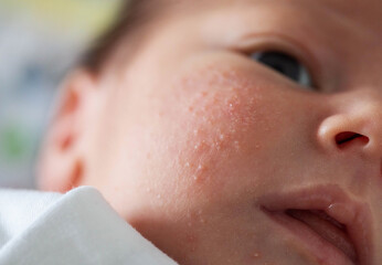 Rash on the face of a newborn baby. The process of formation of the hormonal system, close-up