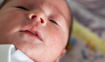 Allergic pimples in a newborn on the face. Pathogenesis, acne of newborns.