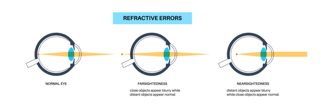 Farsightedness and nearsightedness