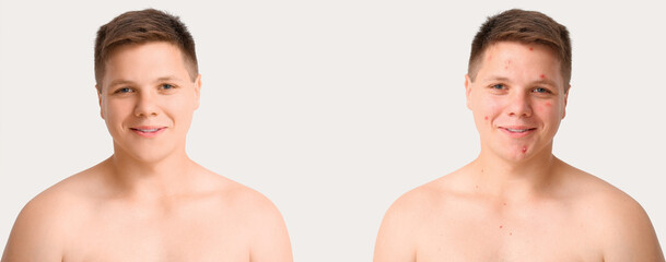 Fototapeta na wymiar Teenage boy before and after acne treatment on white background