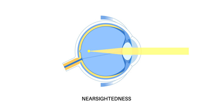 Nearsightedness eye disease