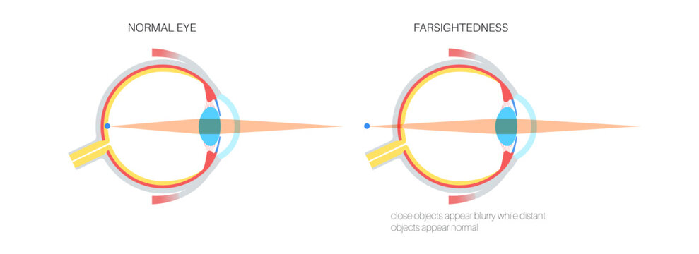 Normal eye and farsightedness
