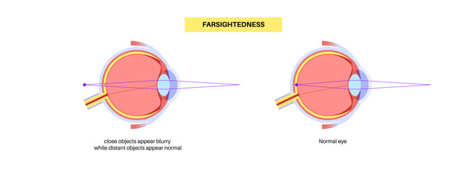 Normal eye and farsightedness