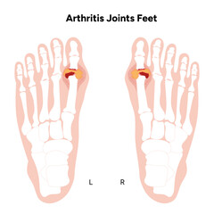 Arthritis joints feet