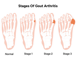 Stages of gout arthritis 