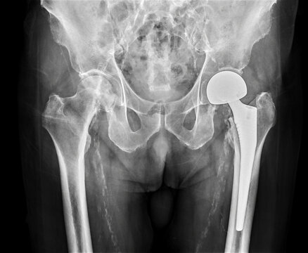 An X-ray reveals both hip joints with TOTAL HIP ARTHROPLASTY, showcasing the success of the surgical procedure and providing a visual testament to the restored mobility and function.