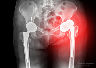 An X-ray reveals both hip joints with prosthetic replacements, showcasing Dislocation of prosthetic...