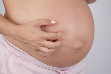 A woman scratches her stomach. Skin allergies during pregnancy.