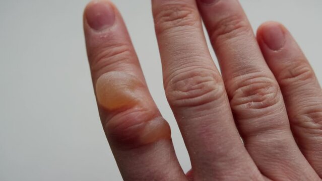 a burn with a blister on a man's finger. White background. First degree burn. Treatment of burns, close-up