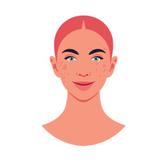 The face of a red-haired young woman with freckles and skin pigmentation on a white background. Dermatology and cosmetology. Vector flat illustration