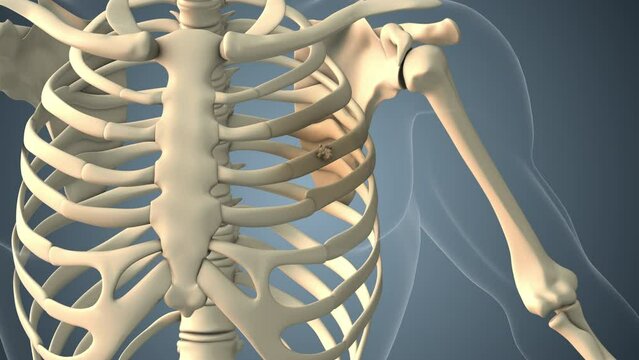 Cancer spreading along a rib bone