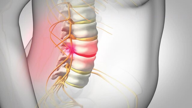 Spinal disc herniation, 3d educational illustration on white background.