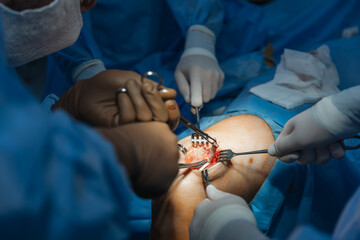 close-up of a severed human knee on an operating table where knee replacement surgery is being...