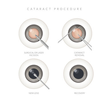 Human Eye - Cataract Procedure - Illustration