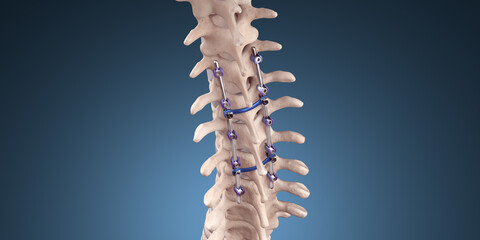 Spine Posterior Thoracic Fusion with Pedicle Screws and Rods on Blue Background