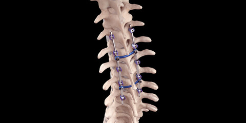 Spine Posterior Thoracic Fusion with Pedicle Screws and Rods on Black Background - obrazy, fototapety, plakaty
