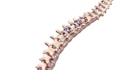 Spine Posterior Thoracic Fusion with Pedicle Screws and Rods on White Background