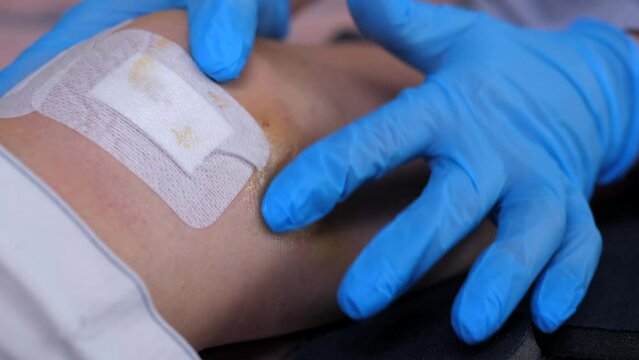 The nurse applies medicated ointment to a hematoma in the knee area near the surgical suture. Consultation with a trauma surgeon. Rehabilitation process after knee surgery