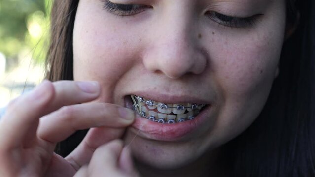 Close up of young woman with dental braces putting rubber bands on her teeth. Elastics in Orthodontic Treatment
