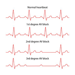 Diagram of normal rhythm and AV block for a human heart. Heart cardiogram. Vector illustration in flat style isolated on white background - obrazy, fototapety, plakaty