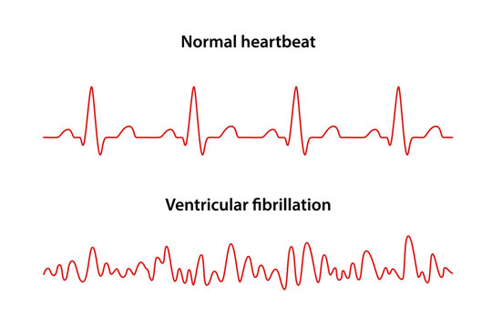 Diagram of normal rhythm and Ventricular fibrillation for a human heart. Heart cardiogram. Vector illustration in flat style isolated on white background