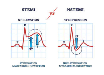 STEMI vs NSTEM heart beat impulse in cardio visualization outline diagram. EKG or electrocardiogram with ST elevation and depression comparison vector illustration. Myocardial infarction example. - obrazy, fototapety, plakaty