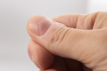 Ridged fingernail of a thumb finger of a man with vertical ridges on white background.