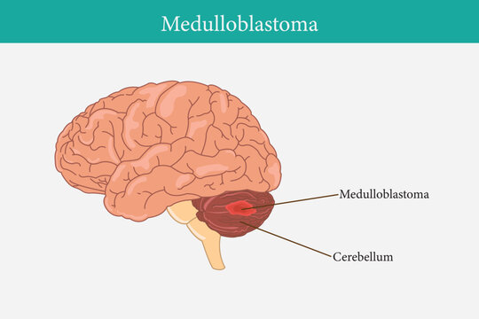 Human anatomy disease. medulloblastoma vector illustration on white background. eps 10