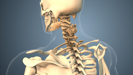 Cancer spreading along a neck bone or vertebral column