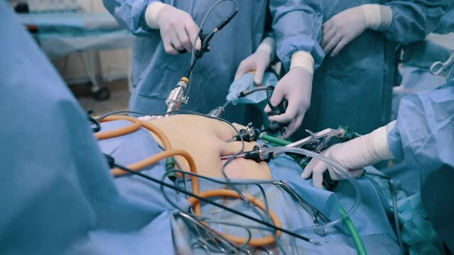 Video endoscopic surgery. A surgeon performs an operation to remove the gallbladder in the clinic. Close up of hands.