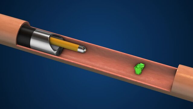 Ureteroscopy with Laser Lithotripsy Treatment for Kidney Stones
