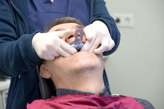 Real shot of a man with a dental impressions tray in a dentist's chair. The doctor's assistant presses the impression with a special blue paste with both hands. Dental prosthetics concept.