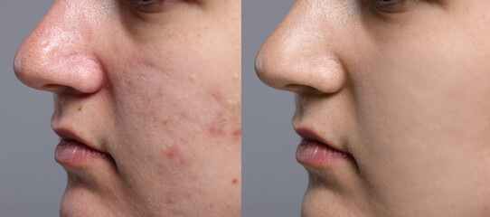 Blackhead treatment, before and after. Collage with photos of woman on grey background, closeup view