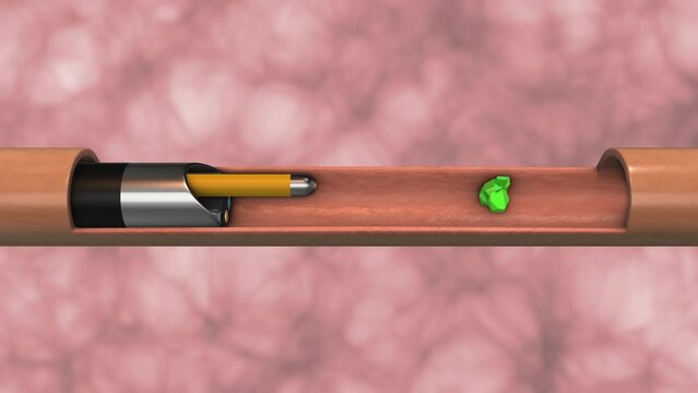 Kidney stone treatment with ureteroscopy and laser lithotripsy