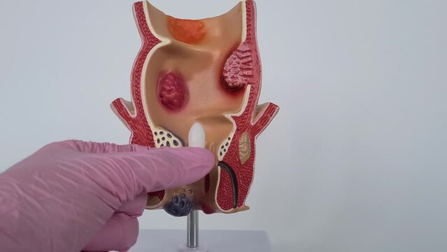 Soft suppository with laxative medicine or for treatment of proctological diseases. Proctologist and constipation treatment