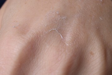 Fototapeta premium Woman with dry skin on hand, macro view