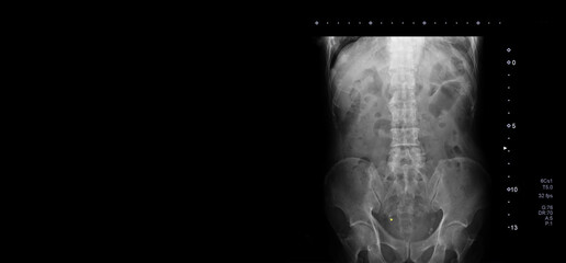x-ray images of spine or spinal,pelvis,hip joint of patient with copy space. wide view
