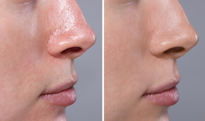 Blackhead treatment, before and after. Collage with photos of woman on grey background, closeup view
