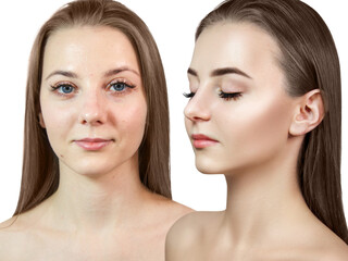 Young woman before and after acne treatment and retouch.