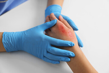 Doctor examining patient's burned hand at table, closeup