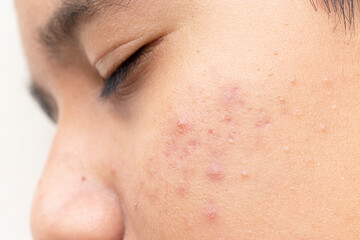 Close up face of teenage guy with acne and problem skin.