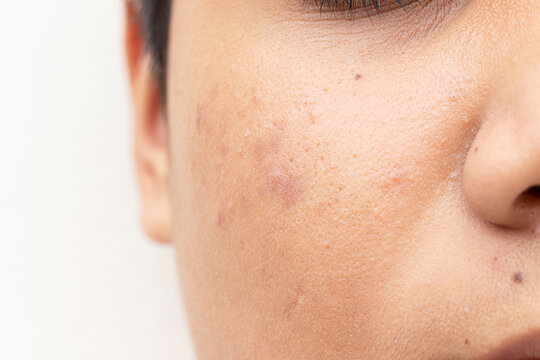 Close up face of teenage guy with acne and problem skin.